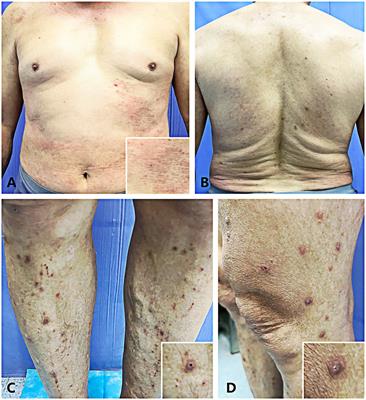 Acquired reactive perforating collagenosis triggered by trauma with eosinophilia: a case report and literature review
